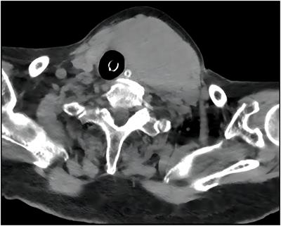 Oncocytic cell carcinoma of the thyroid with TERT promoter mutation presenting as asphyxia in an elderly: a case report